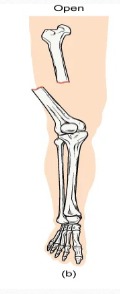 <p>A fracture in which at least one end of the broken bone tears through the skin, carries a very high risk of infection</p>