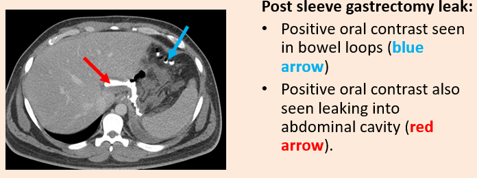 <p>•The timing of administration of the contrast media is also clearly important.</p><p>•If given too long before (or too close to) the time of the CT examination then it may have already passed by (or not yet reached) the area of interest.</p><p>•There is a certain art to getting the timing right as speed of bowel transit varies considerably, especially in disease states.</p><p>•Dependent upon patient/ward to get timing right.</p><p></p>