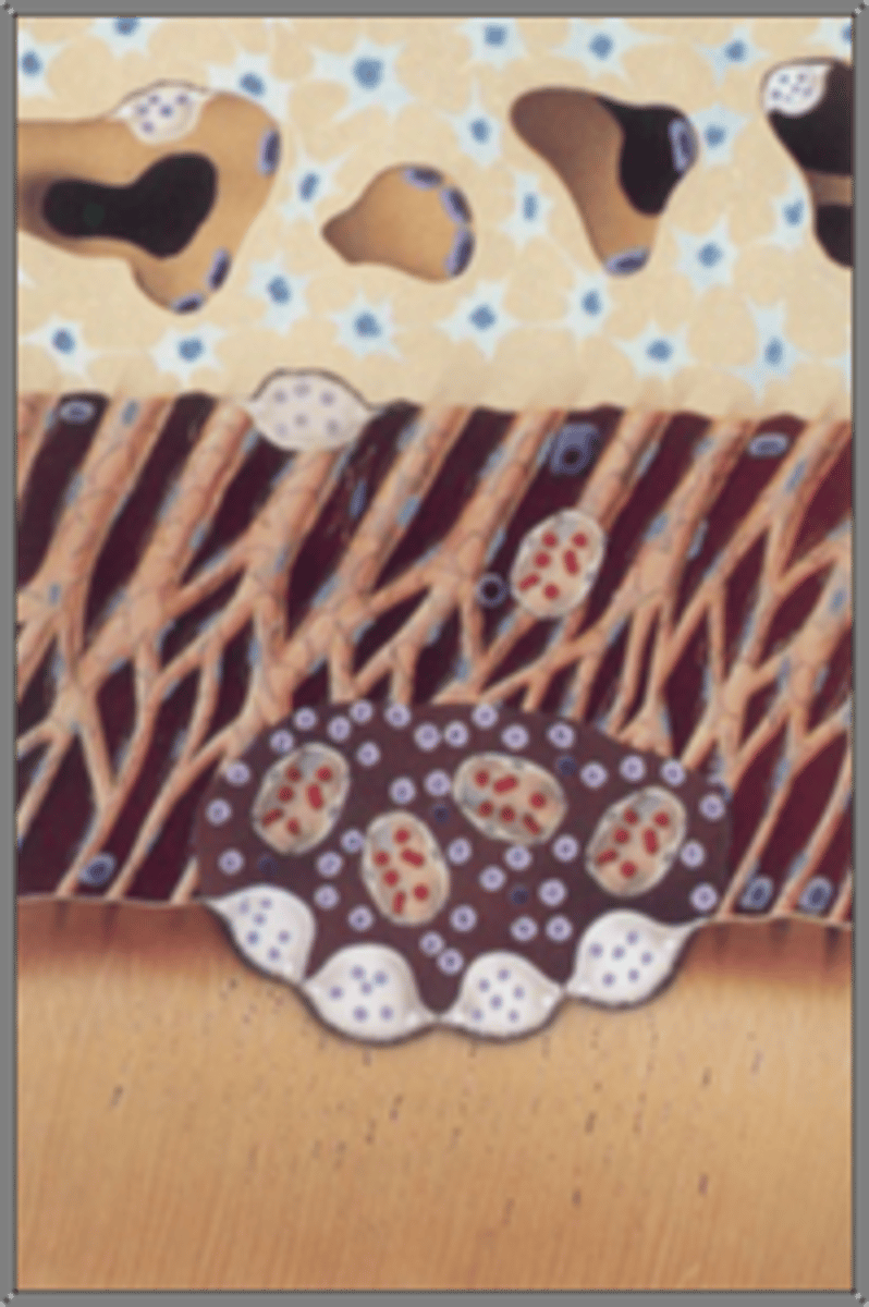<p>•Damage of the periodontium</p><p>•Bacteria within tubules</p><p>•2-visit NS-RCT with Ca(OH)2 can arrest resorptive process and promote healing</p>