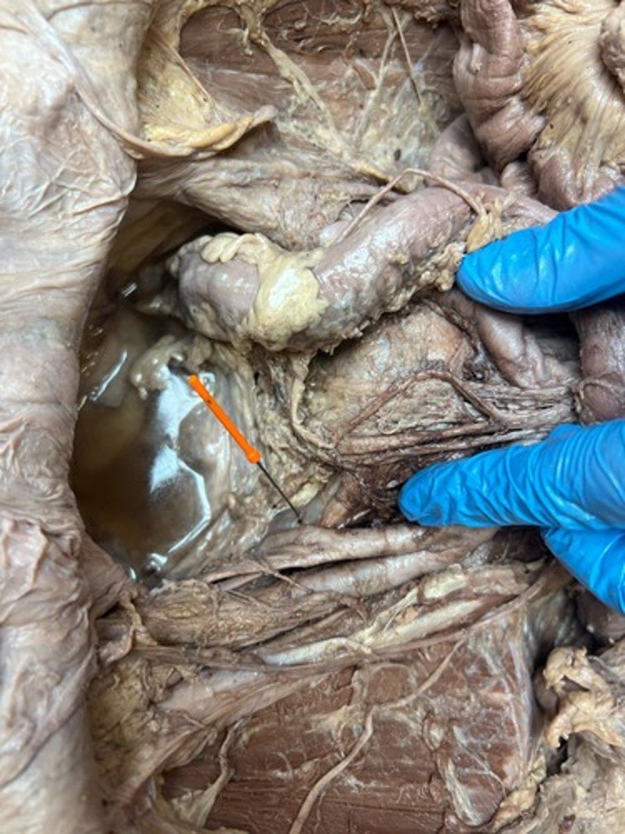 <p>internal iliac vain</p>