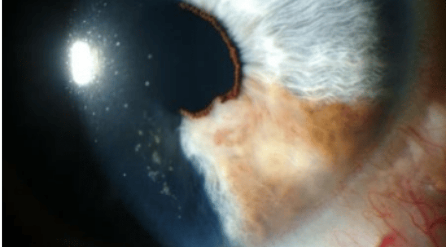 <p>growth of the iris that is more common in light irises and in the inferior aspect. Vary in presentation (pigmented or not, smooth or regular, etc). Are slow growing with low mortality rate. Most commonly appear in the 5th to 6th decade.</p>