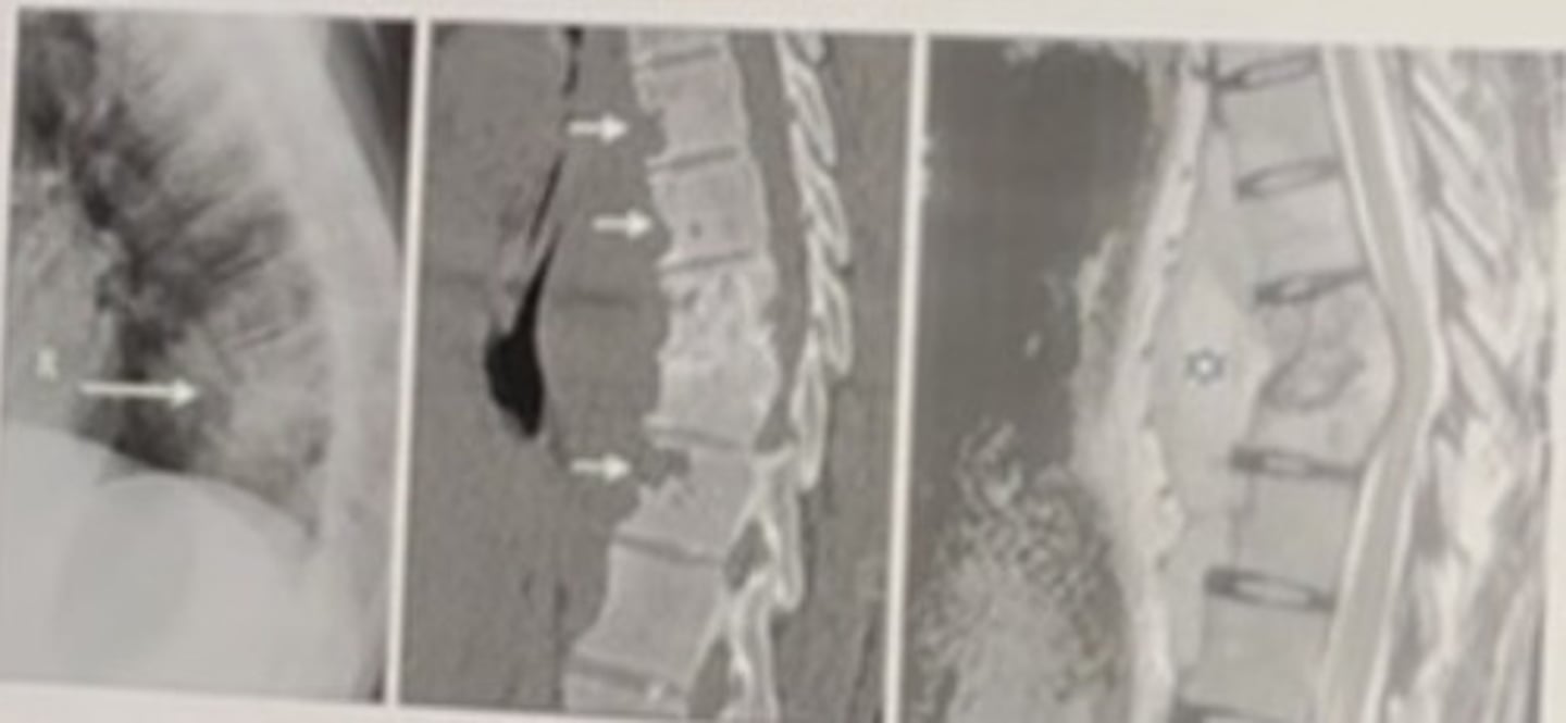 <p>54 year old homeless man with chronic severe mid back pain and also complains of having a long standing cough.</p><p>The above changes are consistent with:</p><p>Neurofibromatosis</p><p>Transient regional osteoporosis</p><p>Dialysis related spondyloarthropathy</p><p>Tuberculous spondylitis</p>