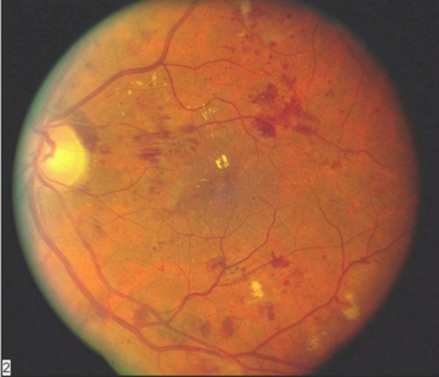 <p>proliferative fundoscopic changes in diabetes</p>
