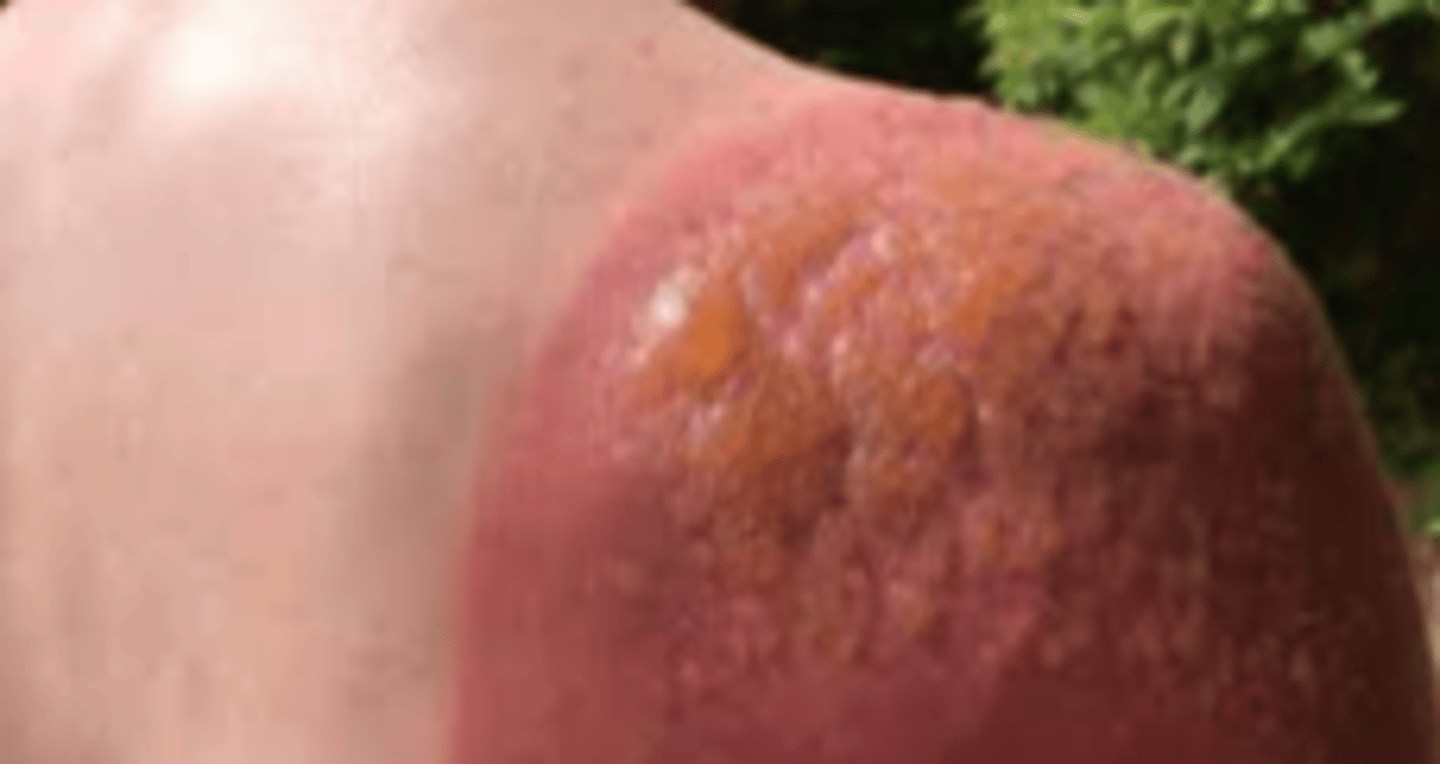 <p>- both epidermis &amp; dermis involved</p><p>- very painful, red, weeping, blisters seen in 24 hours (between the epidermis and dermis) => cap refill normal</p><p>- healing time: up to 3 weeks</p>