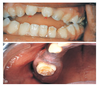 <p>Syphilis can cause Hutchinson’s incisors (notched incisors) and Mulberry molars (globular shaped enamel) </p>