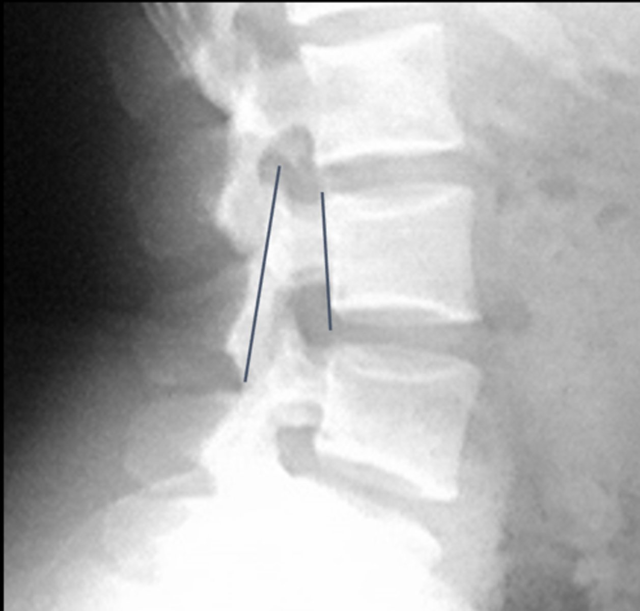 <p>_____ is a sagittal canal measurement</p>