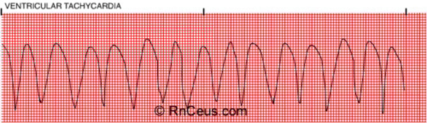 <p>- ectopic foci take over as the pacemaker of the heart leading to wide, distorted QRS intervals (3+ PVCs in a row)</p><p>- Lethal dysrhythmia!</p><p>- Can be pulsing or pulseless (stable or unstable)</p><p>- S/S: hypotension, pulmonary edema, cardiac arrest</p><p>- Treatment: treat underlying cause, stable VT is treated with antidysrhythmic or cardioversion, pulseless VT is treated with CPR and defibrillation</p>