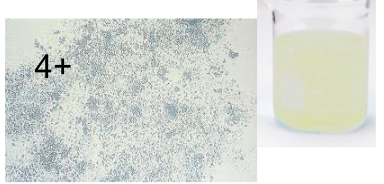 <p>Normal</p><ul><li><p>Phosphates and calcium</p></li><li><p>white sediment</p></li><li><p>Soluble in acetic acid</p></li></ul><p></p>