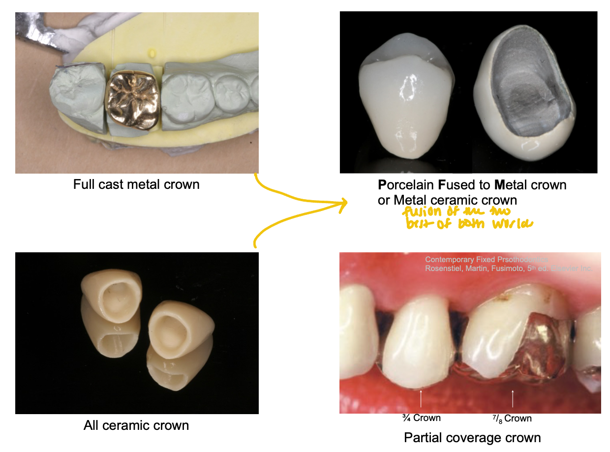 <ul><li><p>full cast metal</p></li><li><p>PFM</p></li><li><p>all ceramic</p></li><li><p>partial coverage (3/4, 7/8)</p></li></ul><p></p>