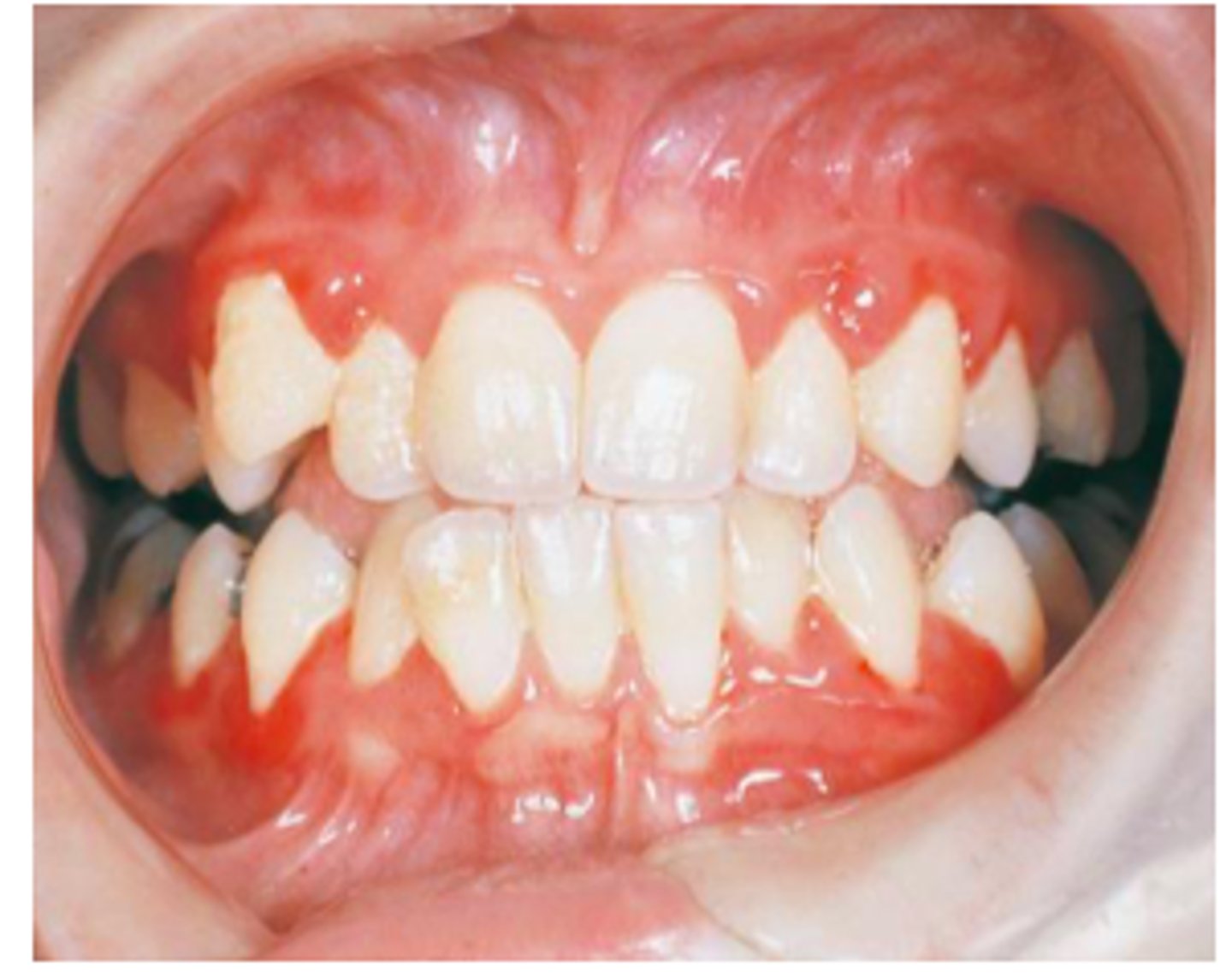 <p>-by decrease in the number of circulating neutrophilic leukocytes, white blood cells help fight infection and remodel the body.</p><p>-autosomal dominant</p>