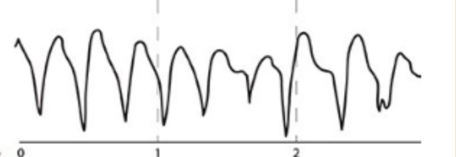 Rapid repetitive contractions of ventricles 

CS- abnormal calcium/ potassium levels, GI diseases 

TX- lidocaine IV 