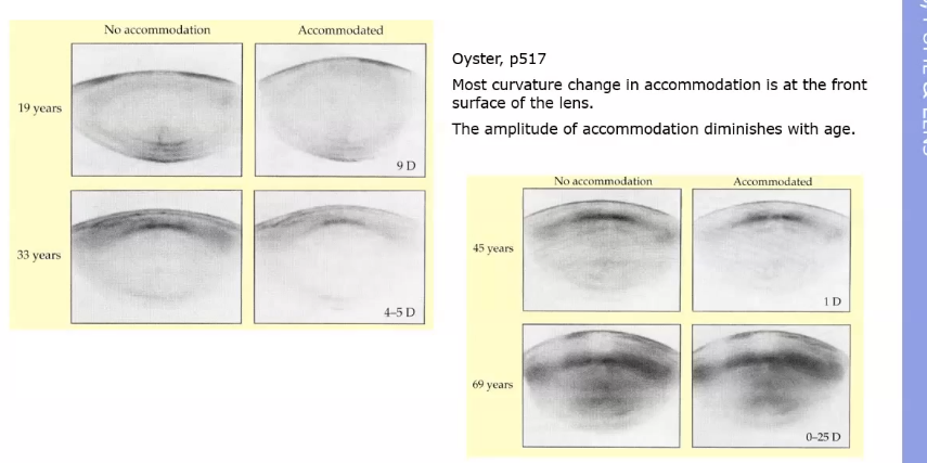 <p>changes as you get older </p><p>younger can accomodating more as front surface of lens is becoming a lot more convex </p>