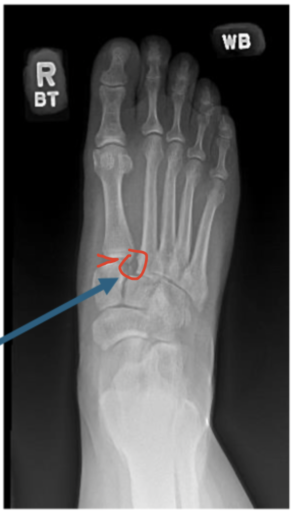 <p>Gameplan for Lisfranc fractures</p>