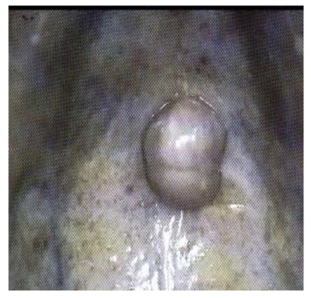 <p>tumor of fibrous tissue</p>