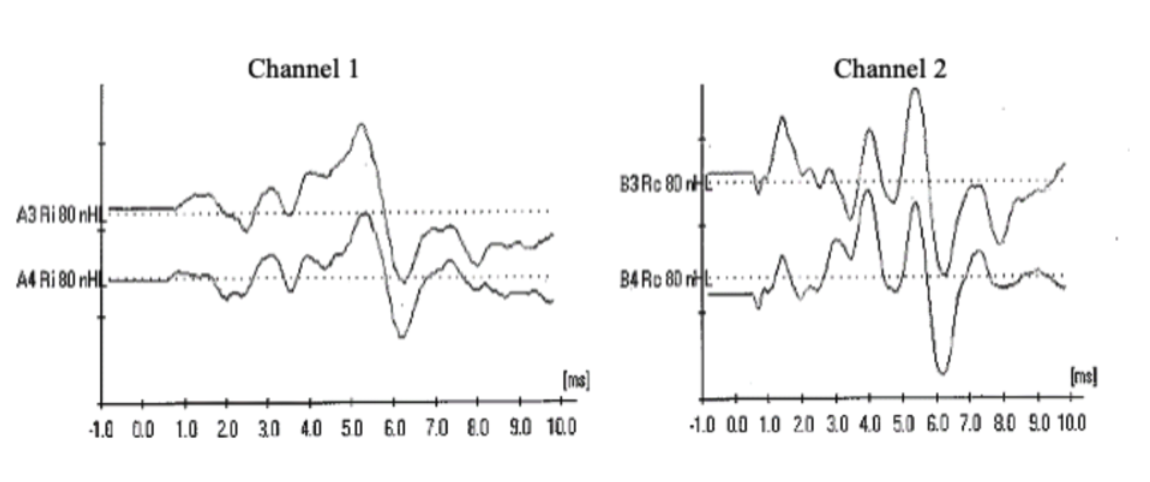 <p>You are recording from a two-channel set-up (ipsi in the first channel, contra in the second). You are stimulating the right ear at 80dB nHL. Why would you be concerned if you recorded the following waves?</p><p></p>