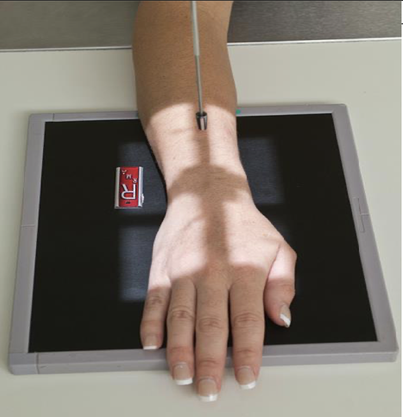 <p>Patient Position</p><ul><li><p><span style="line-height: normal;">&nbsp;</span>Sitting alongside or end of table</p></li><li><p class="p1"><span style="line-height: normal;">&nbsp;</span>Humerus abducted &amp; elbow flexed 90<span style="line-height: normal;">&nbsp;degrees</span></p></li><li><p class="p1"><span style="line-height: normal;">&nbsp;</span>Elbow, forearm, wrist and hand are resting on table</p></li><li><p class="p1"><span style="line-height: normal;">&nbsp;</span>Shoulder and forearm/wrist should be at the same level</p></li><li><p class="p1"><span style="line-height: normal;">&nbsp;</span>May need to raise the table or support the IR on a sponge etc</p></li></ul><p class="p1">Part Position</p><ul><li><p class="p1"><span style="line-height: normal;">&nbsp;</span>Wrist is placed on the IR with hand pronated</p></li><li><p class="p1"><span style="line-height: normal;">&nbsp;</span>Mid-carpal area centered to the IR</p></li><li><p class="p1"><span style="line-height: normal;">&nbsp;</span>Arch hand slightly(10-15<span style="line-height: normal;"> o </span>) to place carpal area in close&nbsp;<span style="font-size: 1.6rem;">contact with the IR</span></p></li></ul><p class="p1">CR</p><ul><li><p class="p1"><span style="line-height: normal;">&nbsp;</span>Perpendicular to IR</p></li><li><p class="p1"><span style="line-height: normal;">&nbsp;</span>Centered to mid carpal area</p></li></ul><p class="p1">Collimation</p><ul><li><p class="p1"><span style="line-height: normal;">&nbsp;</span>include all carpal bones, distal radius &amp; ulna and proximal metacarpal<span style="line-height: normal;">s</span></p></li><li><p class="p1"><span style="line-height: normal;">1/3 of metacarpals and 1/3 of forearm included</span></p></li></ul><p></p>