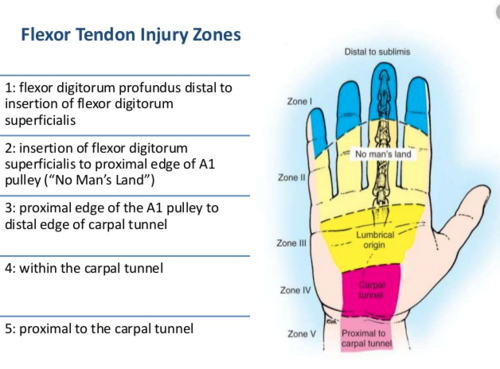 1 - flexor digitorum profundus distal to insertion of flexor digitorum superficialis
2 - insertion of flexor digitorum superficialis to proximal edge of A1 pulley ("no man's land") 
3 - proximal edge of A1 pulley to distal edge of carpal tunnel
4 - within the carpal tunnel
5 - proximal to the carpal tunnel