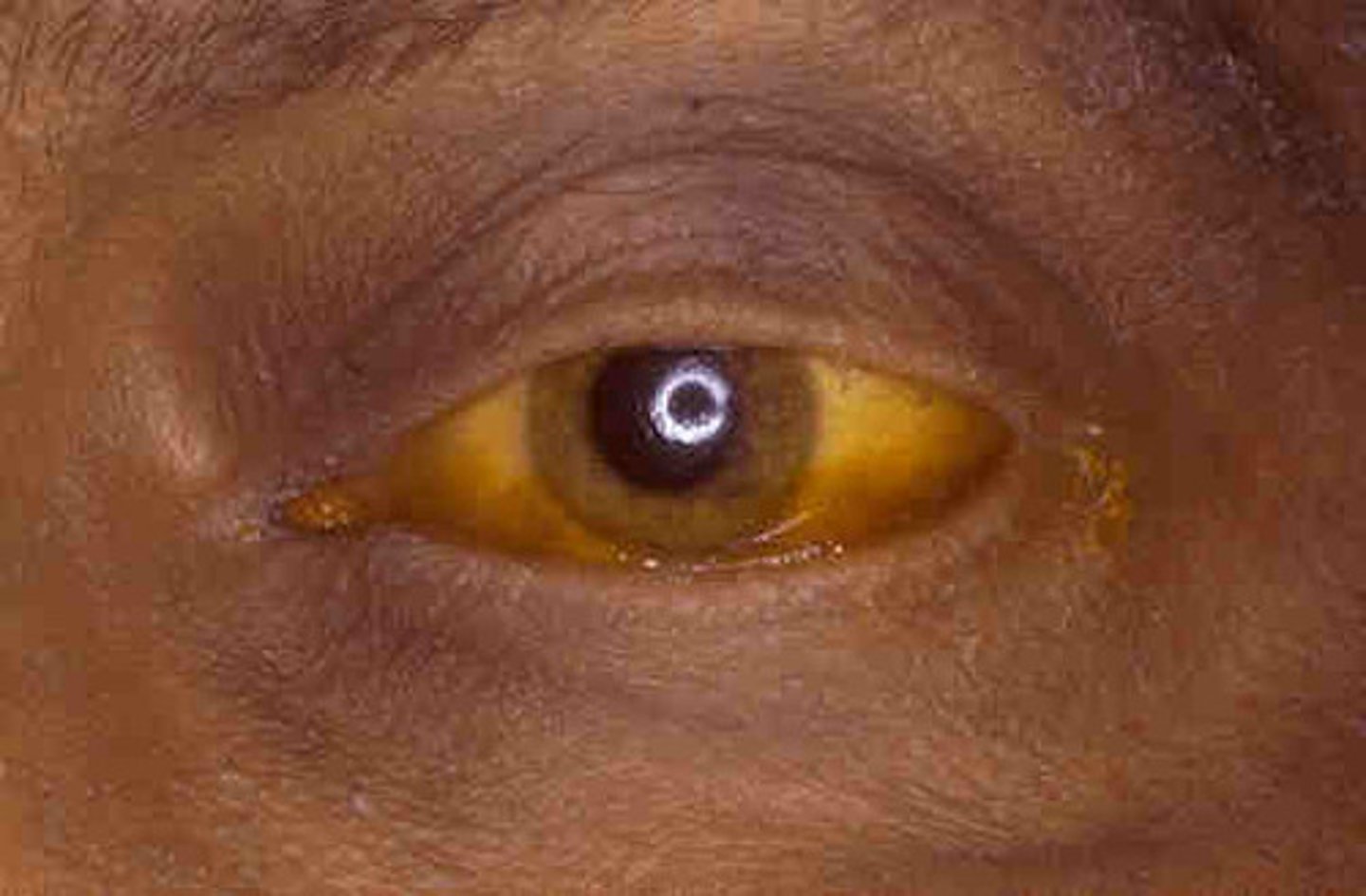<p>-diffuse uniform yellowish discoloration of skin and mucosa </p><p>-sclera, lingual frenum, soft palate</p>