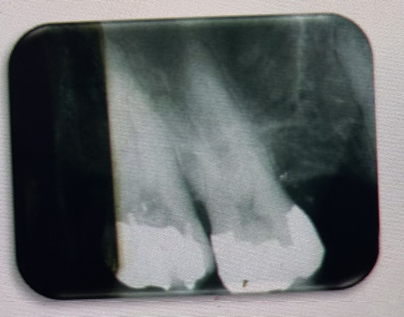 <p>THE PROCESSING ERROR DEPICTED IN THE PICTURE CAN BE DESCRIBED AS WHAT? THE CAUSE WAS DUE TO:</p>