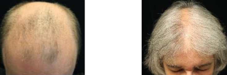 <p>Male - frontal hairline regression, thinning on posterior vertex</p>