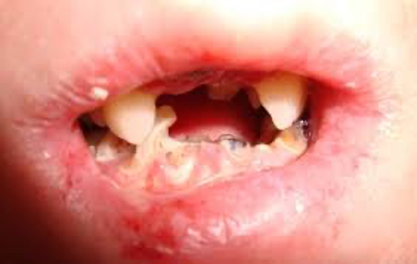 <p>A child presents with blistering of the oral mucosa following minor trauma. What is the MOST likely diagnosis?</p>