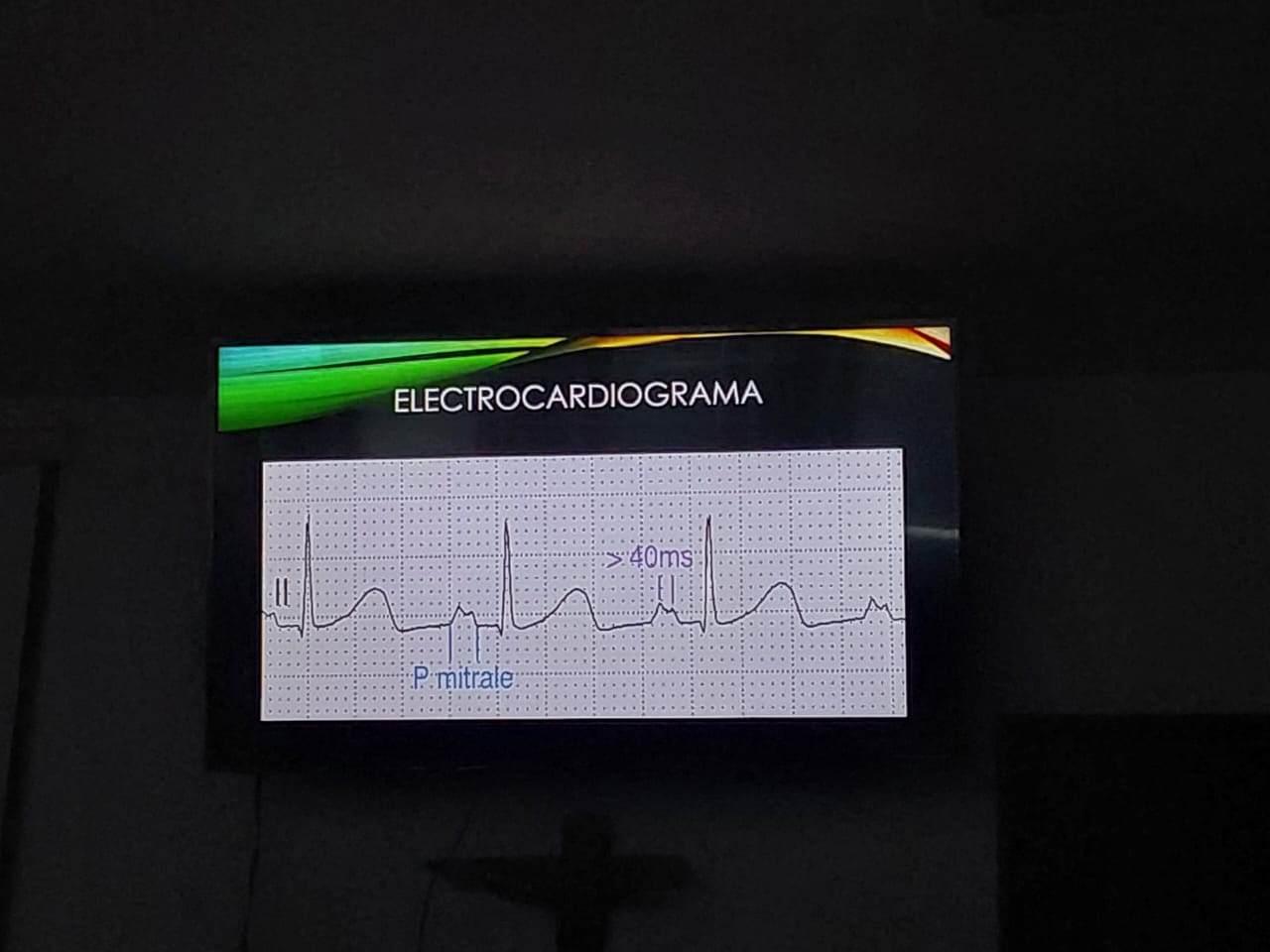 <p>Se le realiza una toma de un electrocardiograma observando el siguiente trazo ¿Cuál es el diagnóstico electrocardiográfico?</p>