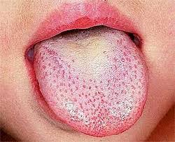 <p>strawberry tongue; rough, red rash</p>