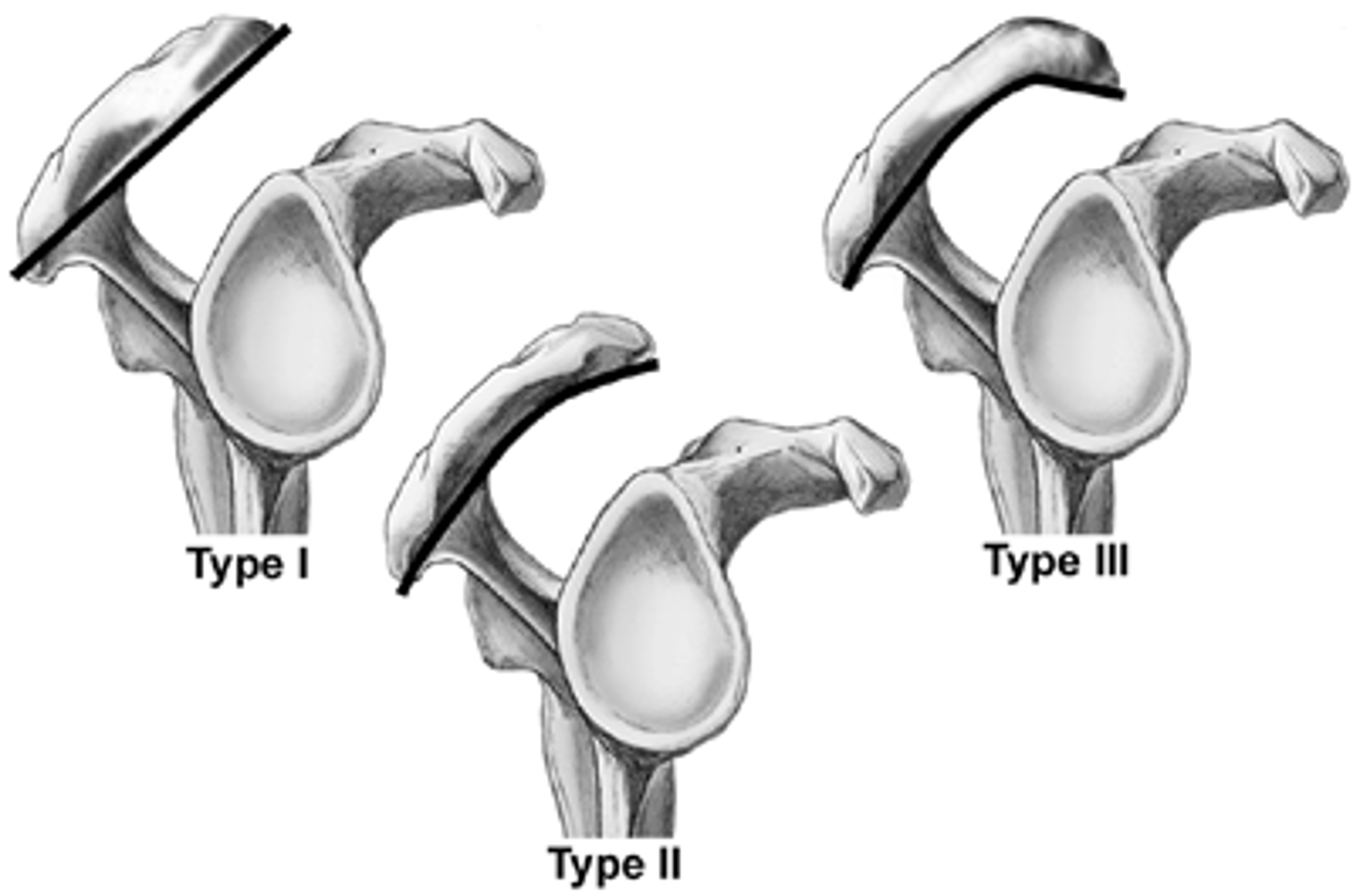 <p><strong>type I=</strong> forms straight angle (best for tendon to run under) </p><p><strong>type II= </strong>small curve </p><p><strong>type III= </strong>hook (can damage tendon) </p>