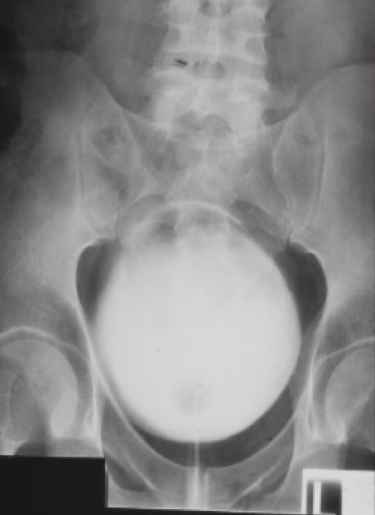 <p>What is this X-ray demonstrating?</p>