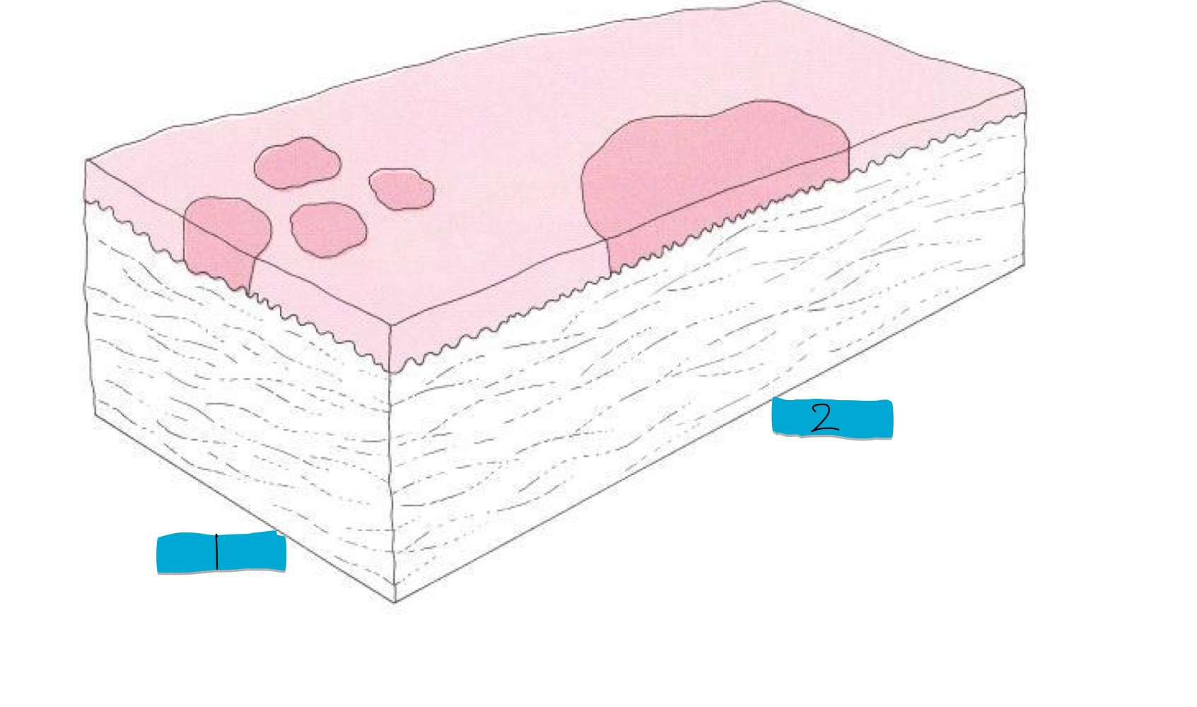 <p>what type of skin lesion are these? </p>