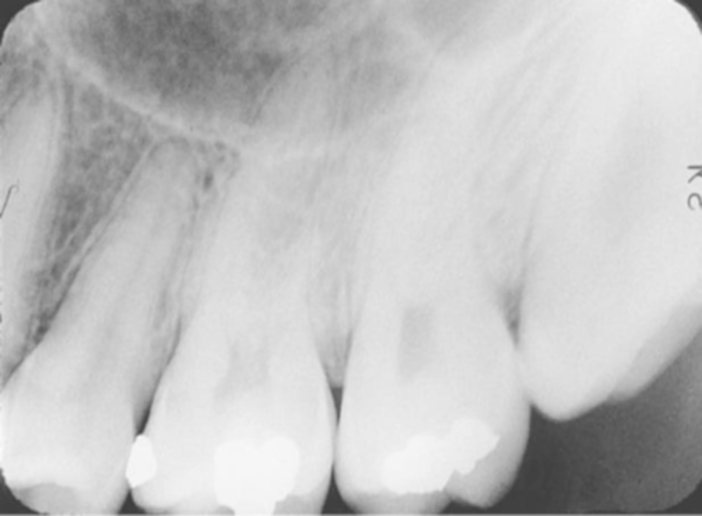 <p>-Images appear stretched and distorted</p><p>-Film was bent excessively because of the curvature of the patient's hard palate</p><p>-Cotton rolls can be used to prevent this for the paralleling and bisecting technique or a film holding device.</p>