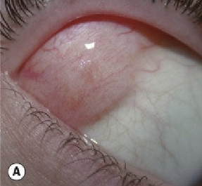 <p>Adults are typically affected. </p>