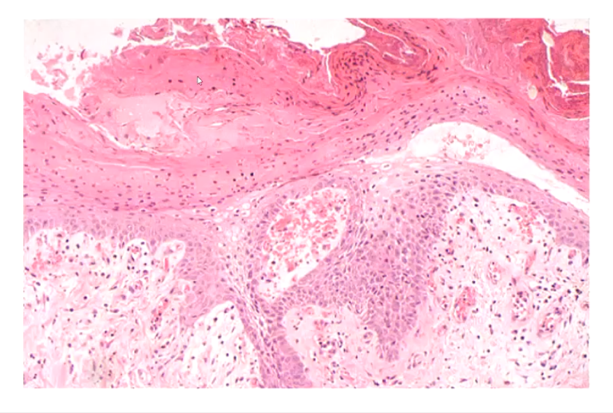 <p>Thickened stratum corneum which has retained nuclei (Not normal)</p>