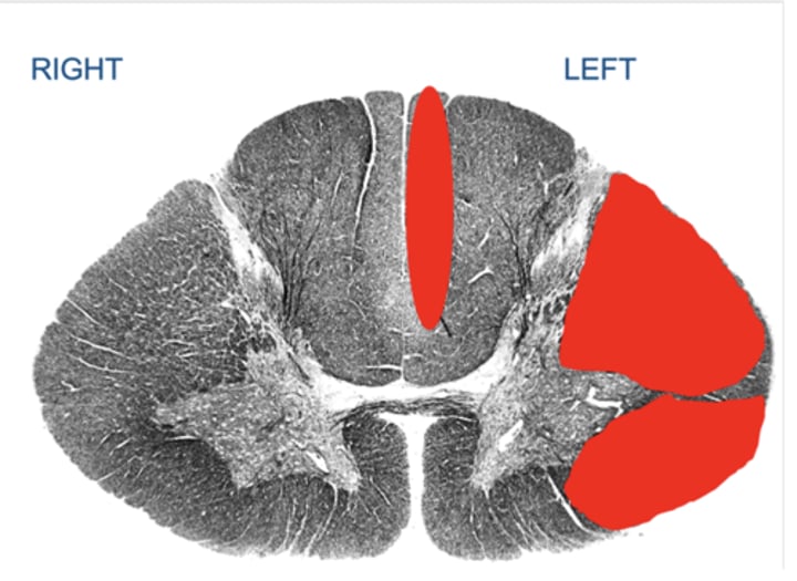 <p>Your patient suffered an injury to the C7 section of the spinal cord. The image below illustrates where the damage (i.e., the lesions) is located by regions covered with red coloring. Note: the image is stained so axons appear dark.</p><p>Which of the following answers best describes the patient's expected sensory changes?</p><p>a) Loss of left leg light touch</p><p>b) Loss of left arm right touch</p><p>c) Loss of right leg light tough</p><p>d) Loss of right arm light touch</p>