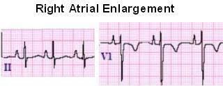 <p>RAE diagnosis:</p>