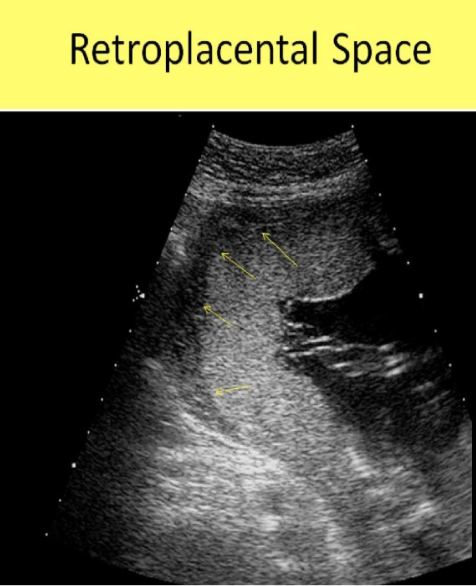 <p>which abn can be r/o by the presence of a <strong>normal</strong> retroplacental space</p><p>.</p><p>a) placenta previa + circumvallate placenta</p><p>b) placenta accreta + placental abruption</p><p>c) fluid in posterior CDS</p><p>d) fluid in anterior CDS</p>