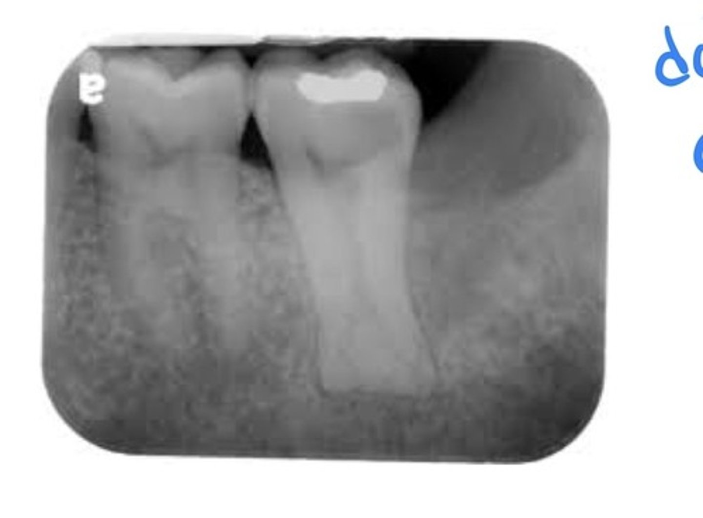 <p>The teeth have elongated pulp chambers and short roots. May occur in both deciduous and permanent dentition. Identified on radiographs. Resemble teeth of bulls.</p>
