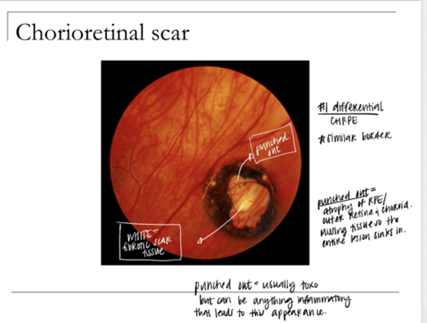 <p>What is the #1 cause of a chorioretinal scar?</p>
