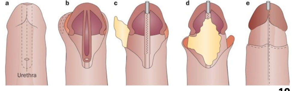 <p>Treatment of Hypospadias:</p><ul><li><p>_______ repair</p><ul><li><p class="p2">Improved micturition and sexual function</p></li></ul></li></ul><p></p>
