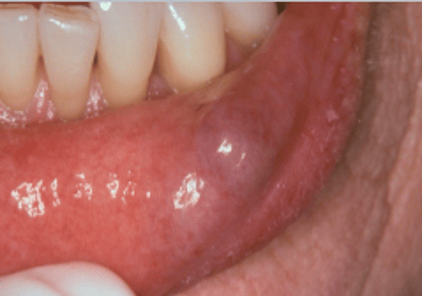 <p>ID the pathology:</p><p>- Traumatized duct spills mucus into adjacent tissues</p><p>- Characteristic history of increasing and decreasing in size</p>