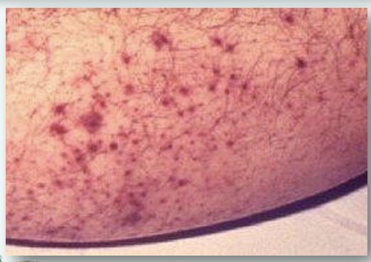 <p>SMALL HEMORRHAGIC SPOTS CAUSED BY CAPILLARY BLEEDING.</p>