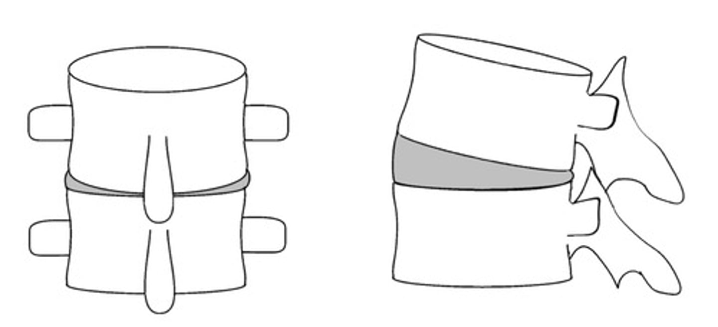 <p>-ΘX rotation restriction (motion listing)</p>