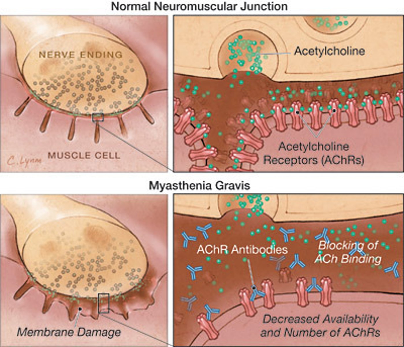 <p>a chronic autoimmune disease that affects the neuromuscular junction by producing antibodies (IgG) against acetylcholine receptors</p><p>- can paralyze diaphragm</p><p>- immunotherapy best cure</p>