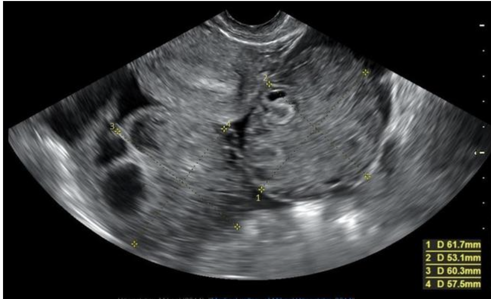 <p>a 27 yo complains of pelvic fullness</p><p>a) ovarian hyperstimulation syndrome </p><p>b) ovarian lymphoma</p><p>c) bilateral endometriomas</p><p>d) Krukenberg tumor </p>