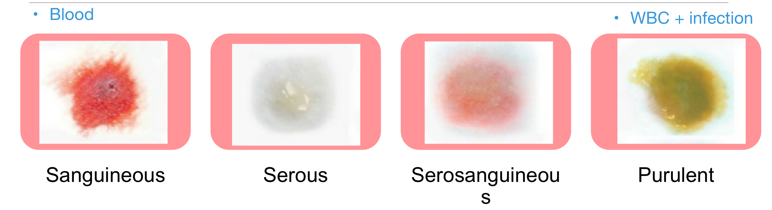 <p>Sanguinous</p><p>Serous</p><p>Serosanguineous</p><p>Purulent</p><p></p>