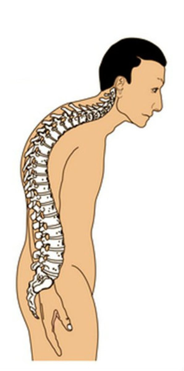 <p>humpback, increased thoracic curvature, loss of height over time, dowager hump</p>