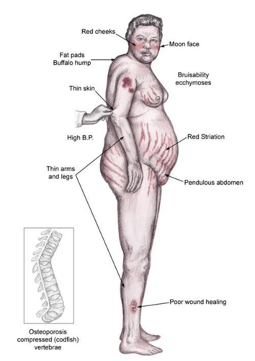 <p>Weight gain, fatigue, proximal muscle weakness, hypertension, insulin resistance, and purple abdominal striae >1cm wide</p>