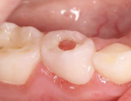 <p>Cariës tot in de pulpa.</p>