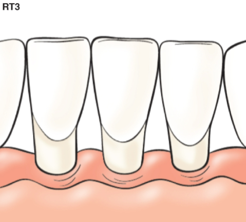 <p>Gingival recession with loss of interproximal attachment</p><p>Amount of interproximal attachment loss greater than buccal attachment loss</p>