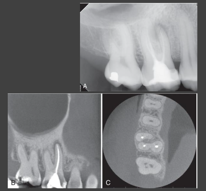 <ul><li><p>Persistent or recurrent inflammatory disease after endodontic treatment</p></li><li><p>Possible etiologies</p><ul><li><p>Inadequate endodontic treatment</p></li><li><p>Unusual root canal morphology</p></li><li><p>Presence of untreated canal</p></li><li><p>Perforation of root surface</p></li><li><p>Root fracture</p></li></ul></li><li><p>CBCT can help determine etiology of persistent or recurrent disease</p></li><li><p>Periapical scar – fibrous healing defect</p></li></ul><p></p>